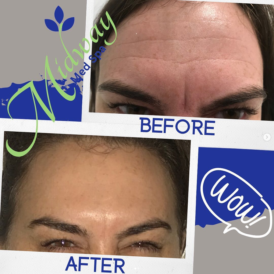 Botox & Neuromodulators