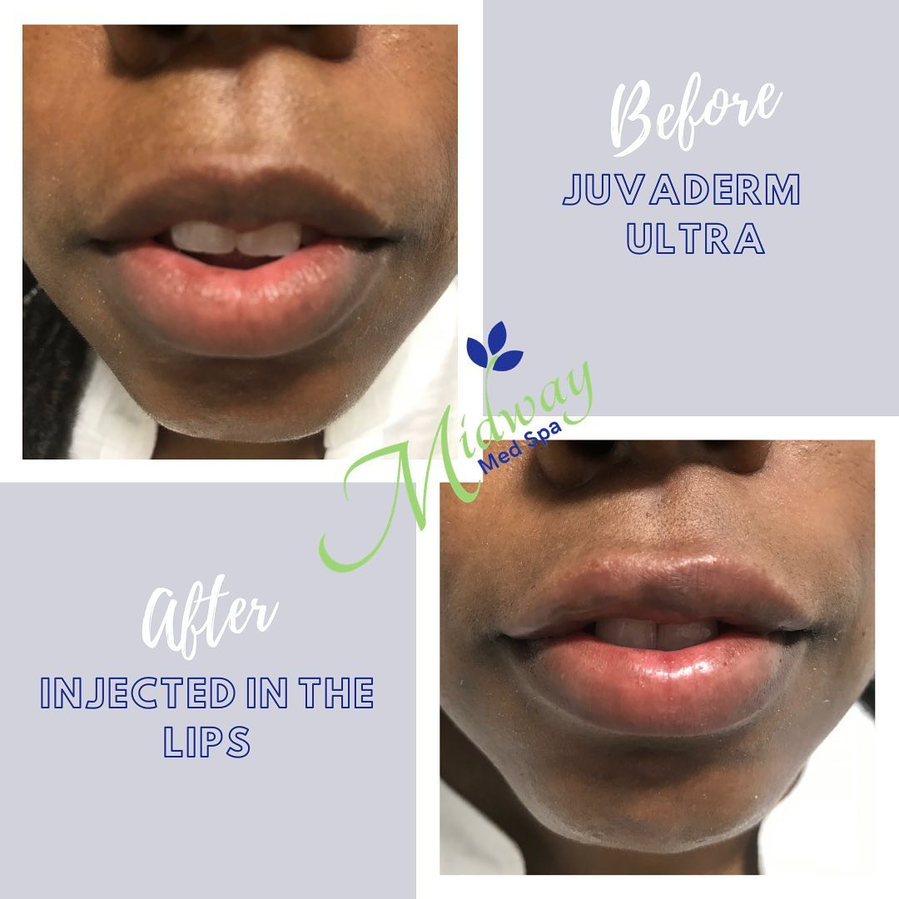 Dermal Fillers