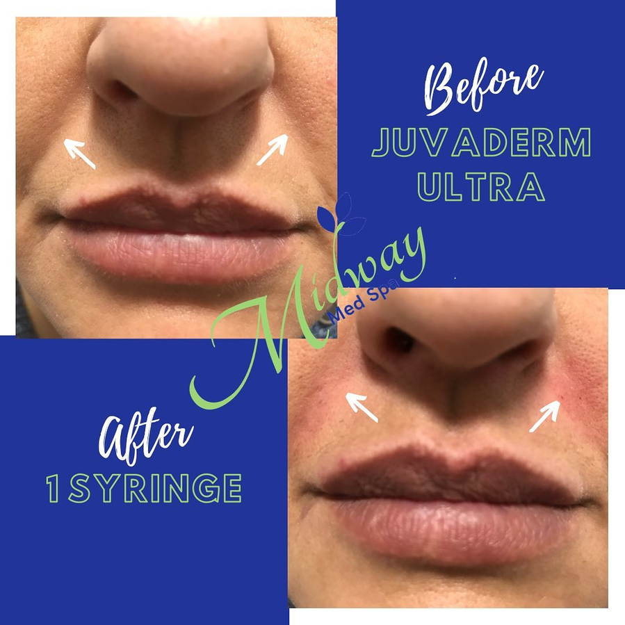 Juvéderm Ultra — 1 syringe lips