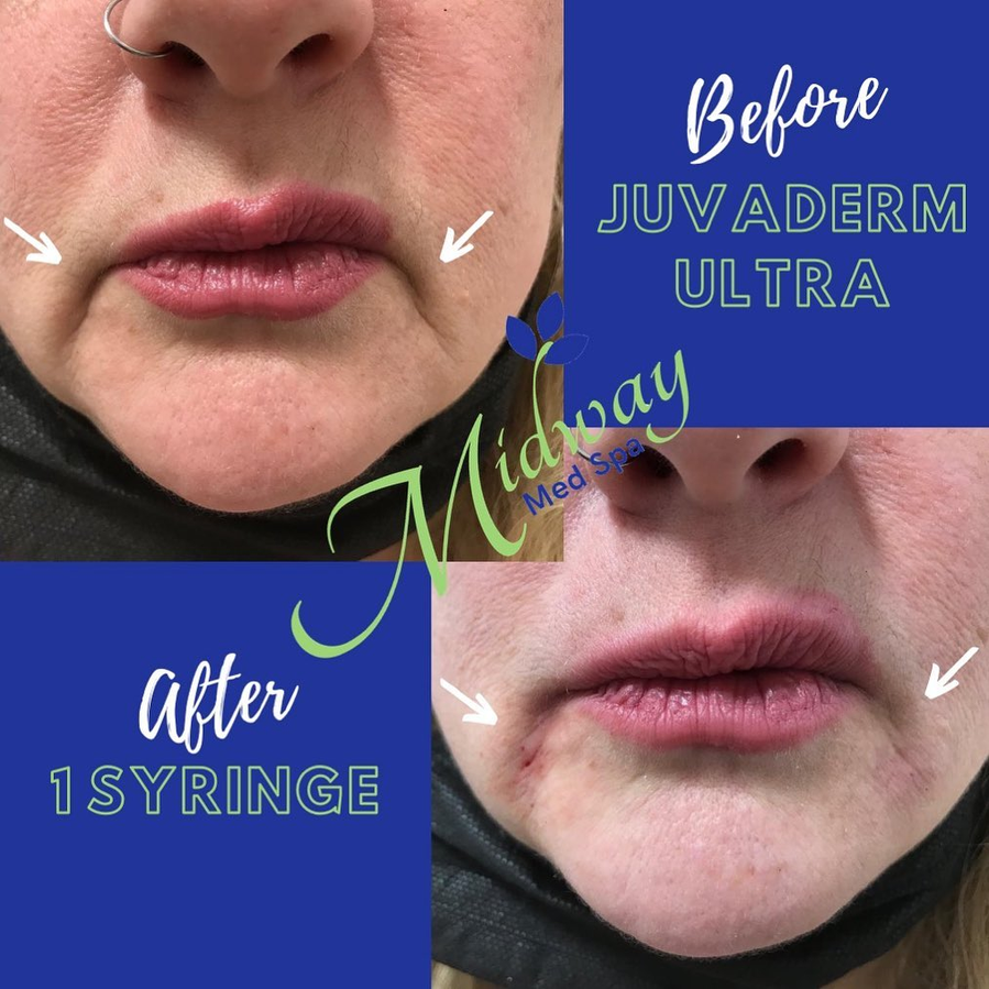 Juvéderm Ultra — Marionette lines, 1 syringe