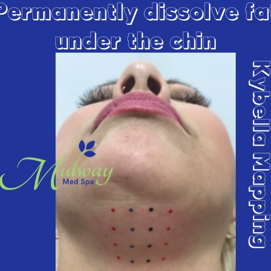 Kybella & Body