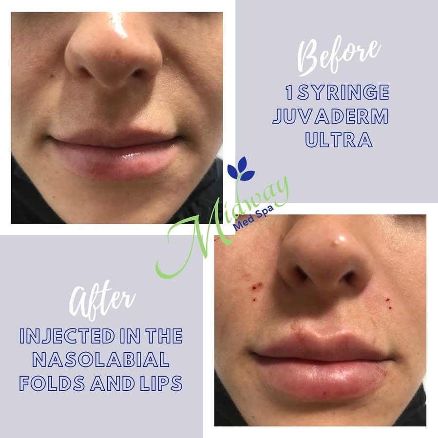 Juvéderm Ultra — Nasolabial folds & lips